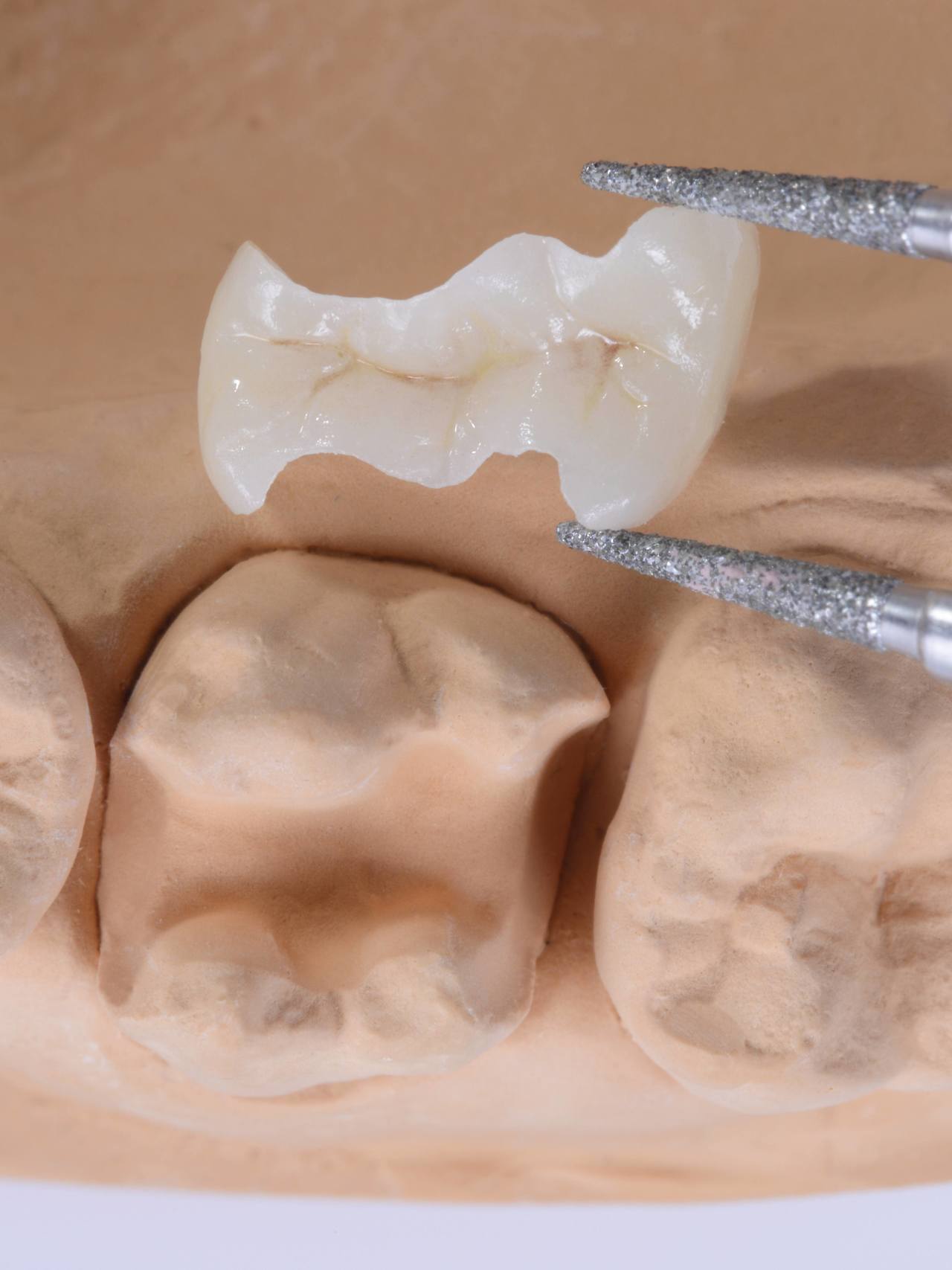 南浦和の審美歯科(白い詰め物・被せ物)