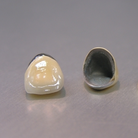 南浦和の審美歯科(白い詰め物・被せ物)