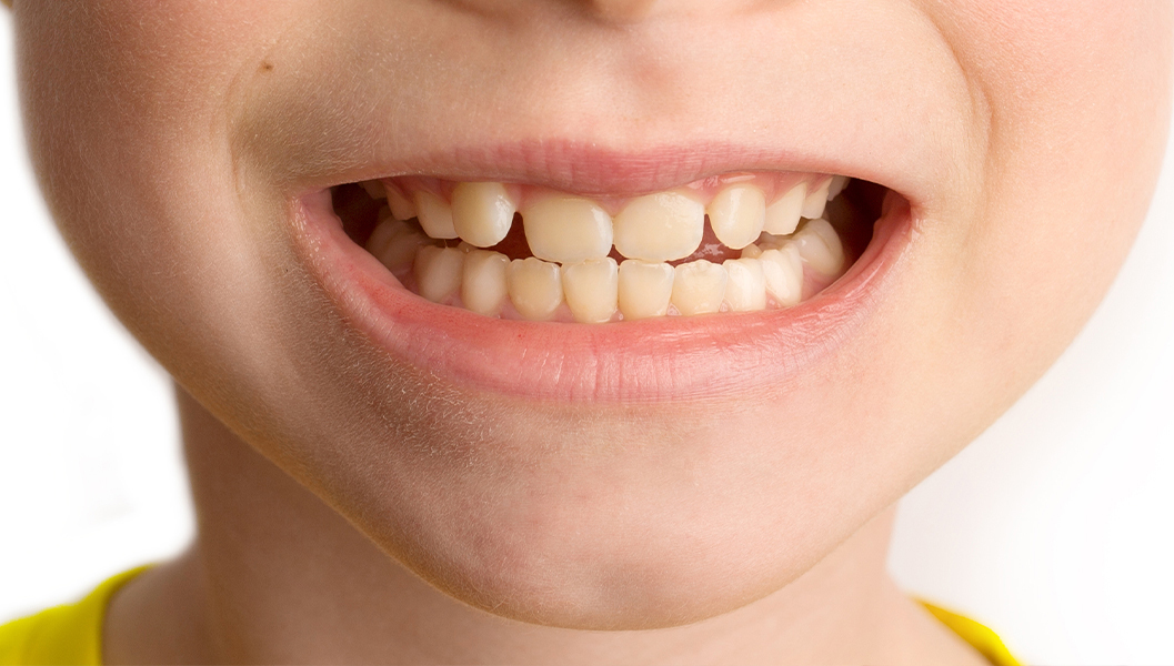 南浦和の小児歯科治療