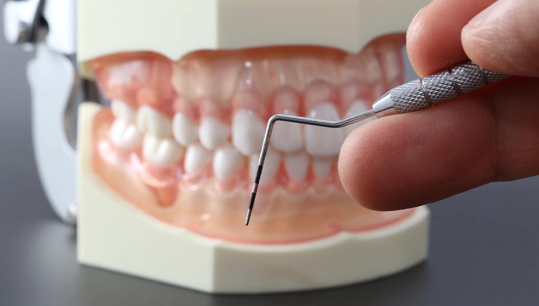 南浦和の歯周病治療