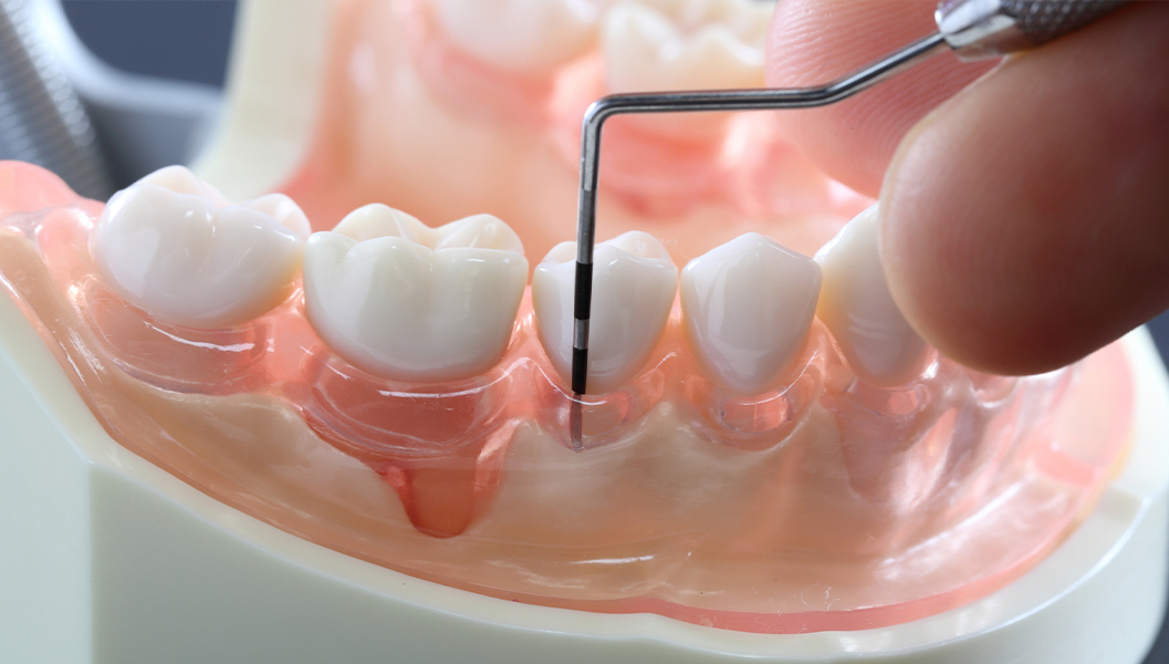 南浦和の歯周病治療