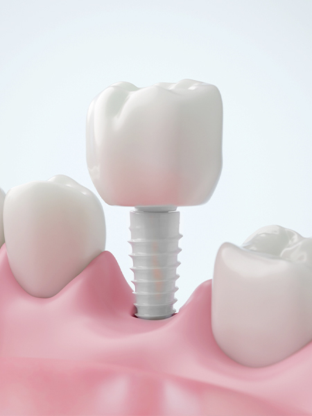 南浦和のインプラント治療