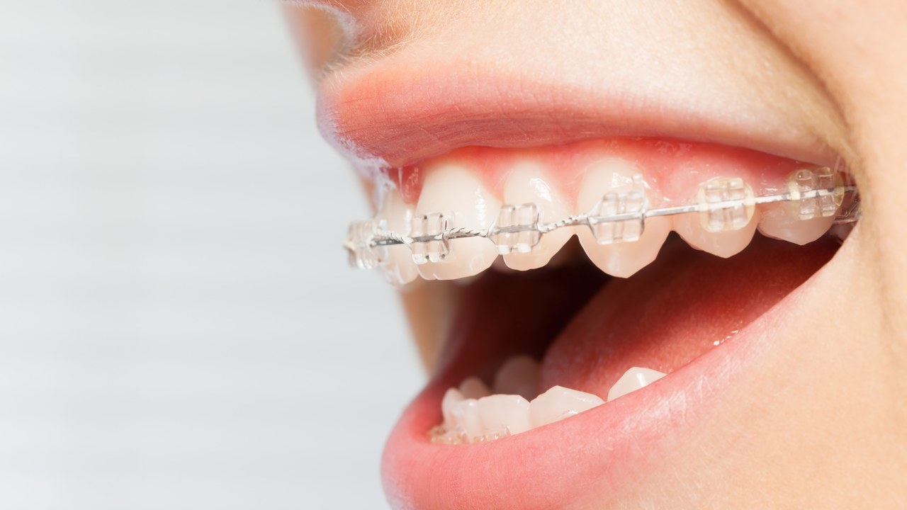 南浦和の矯正歯科治療