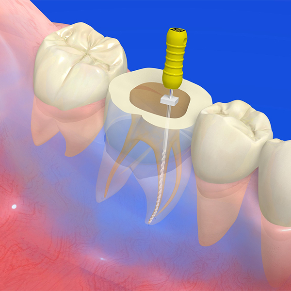 南浦和の虫歯治療